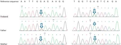 Clinical Characteristics, In Silico Analysis, and Intervention of Neonatal-Onset Inflammatory Bowel Disease With Combined Immunodeficiency Caused by Novel TTC7A Variants